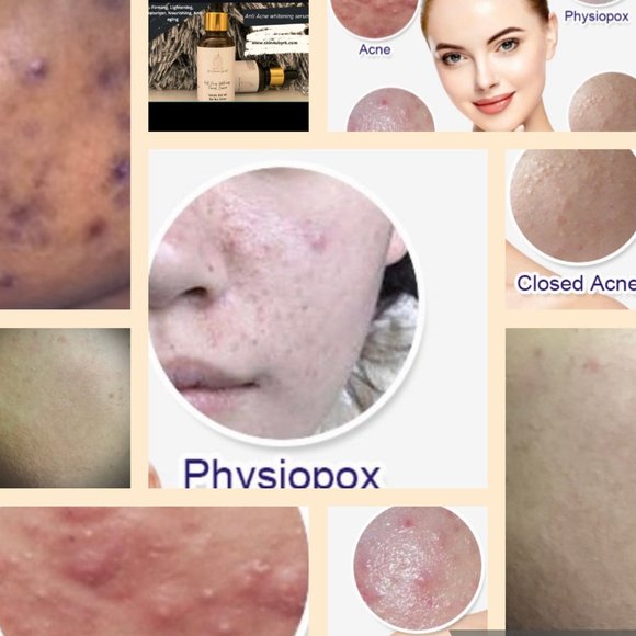 Anti acne serum - Picture 2 of 3